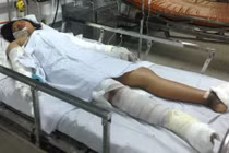 Bé gái bị mẹ đốt ở Bình Thuận quằn quại chống tử thần