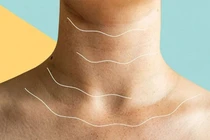 3 dấu hiệu “lạ” ở cổ cảnh báo ung thư đã “tấn công” cơ thể