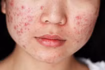 Mỹ phẩm nhiễm độc thủy ngân nhận biết như thế nào