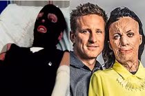 Chuyện tình ngưỡng mộ của cô gái có khuôn mặt biến dạng