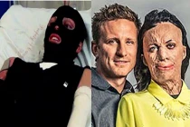 Chuyện tình ngưỡng mộ của cô gái có khuôn mặt biến dạng