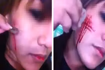 Xôn xao thiếu nữ dùng dao lam rạch nát mặt