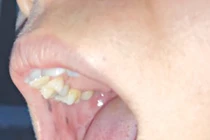 Phát hiện sớm bệnh hiểm từ các nốt sắc tố sậm màu trong miệng