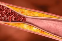 Video: Mỡ máu cao một đi không trở lại nếu dùng món ăn này