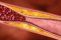 Video: Mỡ máu cao một đi không trở lại nếu dùng món ăn này