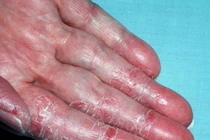 Bong da ngón tay, khắc phục thế nào?