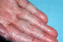 Bong da ngón tay, khắc phục thế nào?