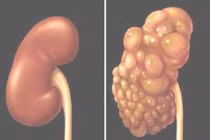 Bệnh thận đa nang và các biến chứng