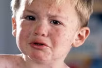 Bác sĩ Viện Nhi TƯ chỉ ra cách phân biệt bệnh sởi và sốt phát ban