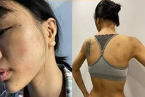 Siêu mẫu Khả Trang tung ảnh tố bị đánh đập bầm dập: Xử sao kẻ bạo hành?