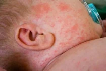 Dịch sởi nghiêm trọng nhất trong nhiều năm tại Mỹ