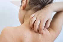 Nhiều bệnh nhi nhập viện do mắc sởi