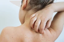 Nhiều bệnh nhi nhập viện do mắc sởi