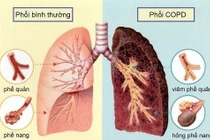 Cách phát hiện bệnh phổi tắc nghẽn mãn tính - COPD