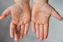 TP HCM có 476 ca mắc bệnh chân tay miệng trong tuần qua