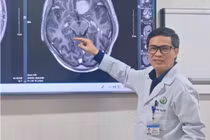 Phẫu thuật nội soi u não qua cung mày, ít xâm lấn