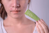 8 cách trị mụn tại nhà hiệu quả ngay lần đầu sử dụng