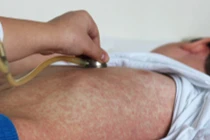 Cả nước thêm 2 ca tử vong do mắc sởi trong tuần qua