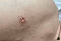 Phát hiện thêm ca bệnh giun rồng thứ 26 tại Phú Thọ