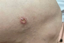 Phát hiện thêm ca bệnh giun rồng thứ 26 tại Phú Thọ
