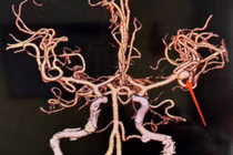 Đột ngột đau đầu sau khi tắm, người phụ nữ suýt tử vong