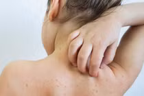 Hà Nội ghi nhận 120 ca mắc sởi trong quần qua