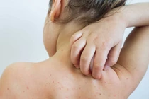 Hà Nội ghi nhận 120 ca mắc sởi trong quần qua