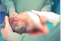 Ca sinh hiếm gặp, em bé chào đời vẫn nằm nguyên trong túi ối
