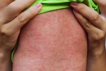 WHO kêu gọi hành động khẩn cấp ứng phó bệnh sởi