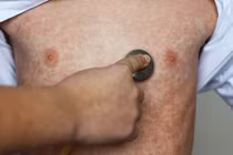 Hà Nội ghi nhận 96 ca mắc sởi trong tuần qua