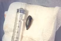 Gắp thành công hạt hồng xiêm ra khỏi phế quản cụ ông 85 tuổi