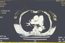 Cứu sống bệnh nhân tắc động mạch phổi bằng kỹ thuật tiêu sợi huyết