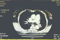 Cứu sống bệnh nhân tắc động mạch phổi bằng kỹ thuật tiêu sợi huyết