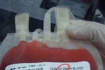 Kỹ thuật mới: phát hiện HIV trong 11 ngày 