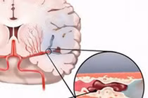 Đau nửa đầu vai gáy có phải thiếu máu não?