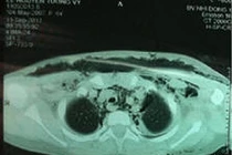 TP.HCM: Điều trị thành công ca viêm mạc hoại tử cổ mặt hiếm gặp