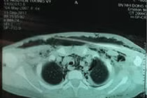 TP.HCM: Điều trị thành công ca viêm mạc hoại tử cổ mặt hiếm gặp