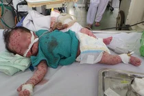 Cứu sống bé sơ sinh bị thủy đậu chứng xuất huyết phổi