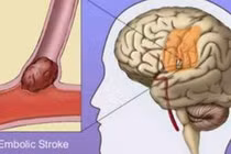 85% bệnh nhân bị thiếu máu não biến chứng và tử vong