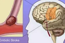 85% bệnh nhân bị thiếu máu não biến chứng và tử vong
