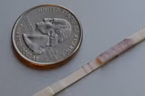 Giấy thử ung thư qua nước tiểu