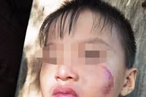 Bé 6 tuổi Bình Phước bị mẹ ruột đánh tím mặt, bầm người: Nguyên nhân càng...phẫn nộ