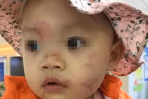 Nghi vấn bé gái 14 tháng bị “đánh” bầm dập ở lớp mầm non Hoa Sen