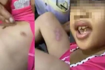 Mẹ nghiện ngập, cha ghẻ châm tàn thuốc cháy người bé gái 6 tuổi