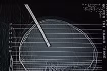 Bỗng nhiên bị cây sắt rơi trúng đầu, xuyên sâu 10cm 