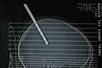 Bỗng nhiên bị cây sắt rơi trúng đầu, xuyên sâu 10cm 