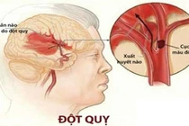 5 việc đơn giản giảm nguy cơ đột quỵ