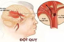 5 việc đơn giản giảm nguy cơ đột quỵ