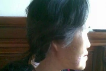 Một phụ nữ bị chó cắn nát mặt, rách chân