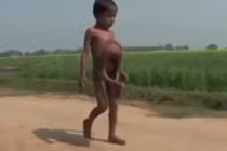 Cậu bé được tôn là thần vì có 4 tay 4 chân